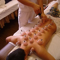 Fire cupping being performed